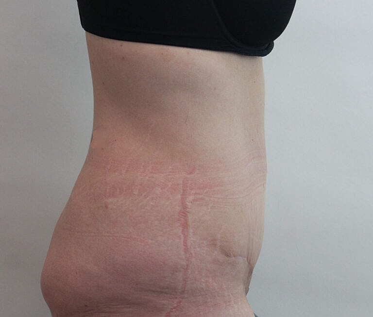 Abdominoplasty Tummy Tuck Before & After