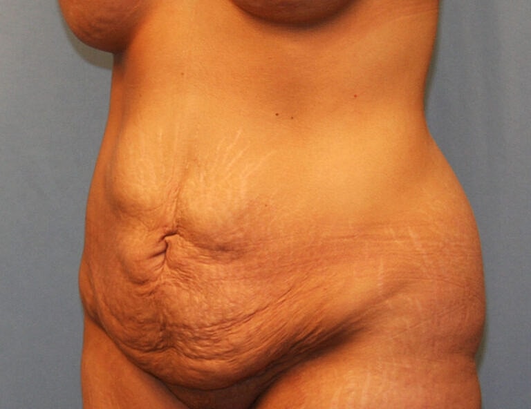 Abdominoplasty Tummy Tuck Before & After