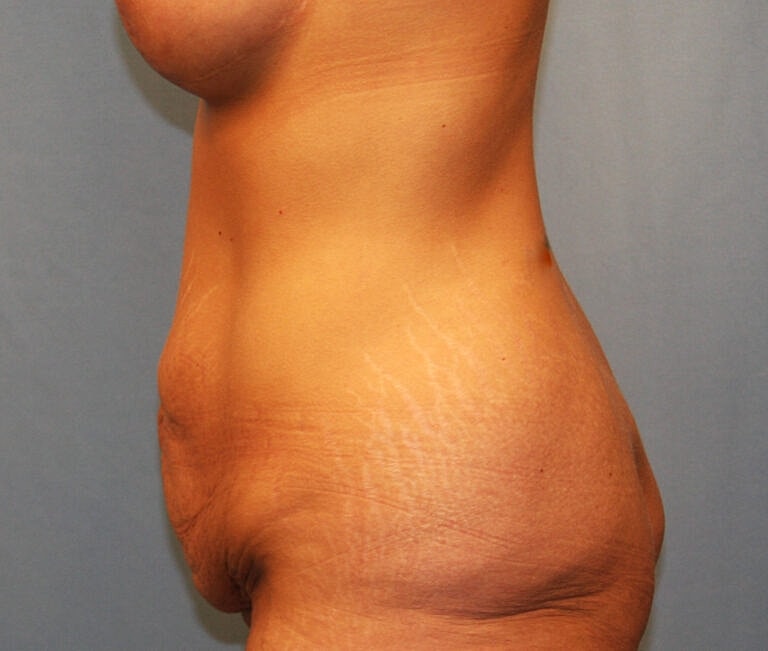 Abdominoplasty Tummy Tuck Before & After