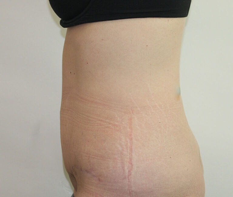 Abdominoplasty Tummy Tuck Before & After