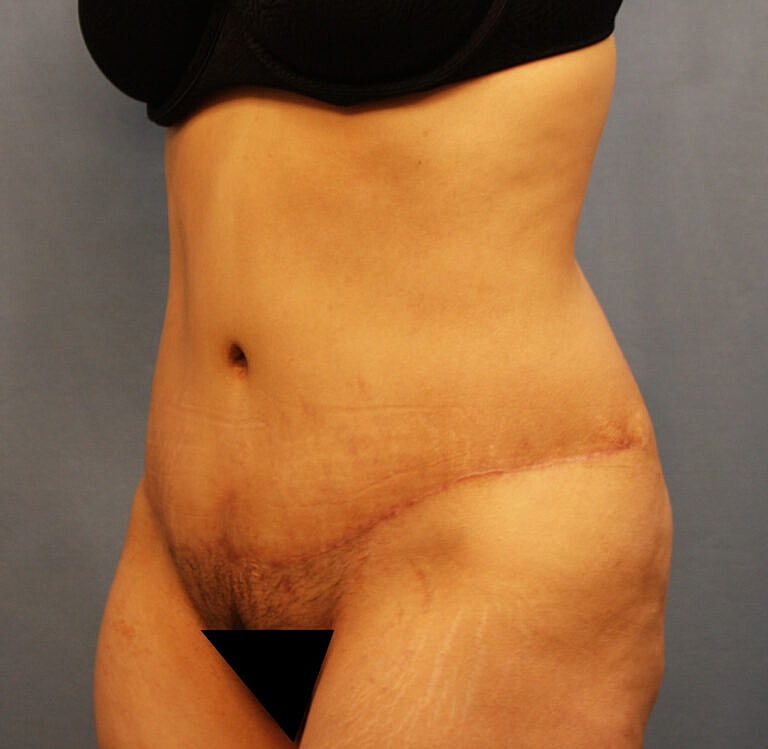 Abdominoplasty Tummy Tuck Before & After