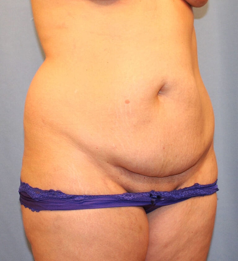 Abdominoplasty Tummy Tuck Before & After