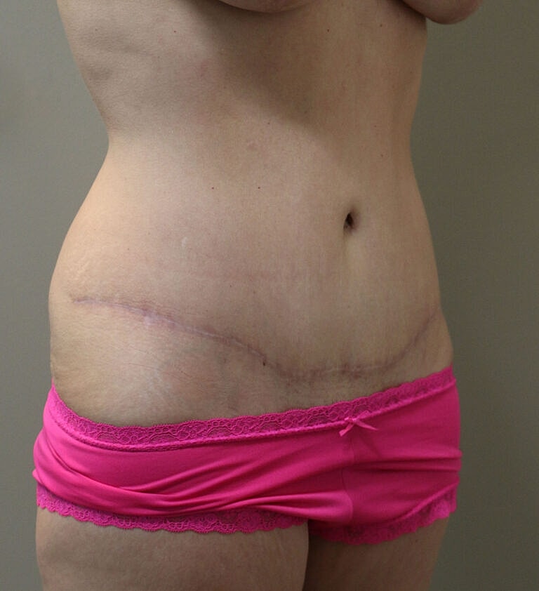 Abdominoplasty Tummy Tuck Before & After