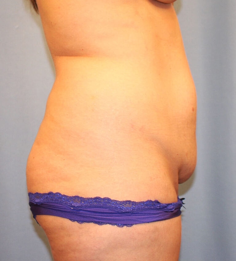 Abdominoplasty Tummy Tuck Before & After