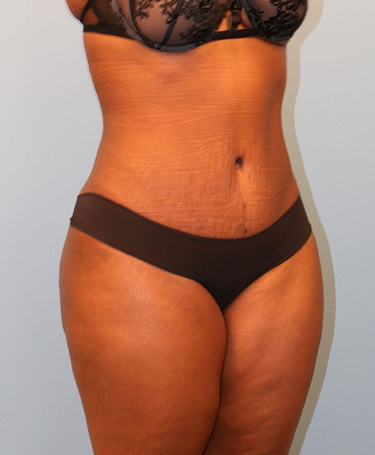 Abdominoplasty Tummy Tuck Before & After