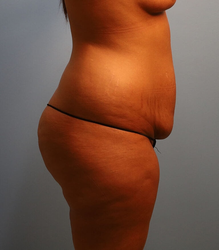 Abdominoplasty Tummy Tuck Before & After