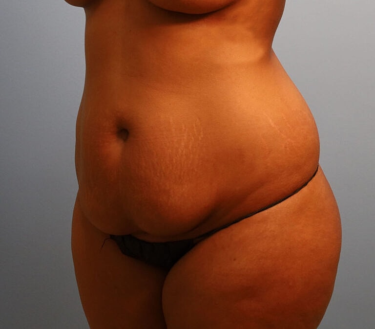 Abdominoplasty Tummy Tuck Before & After