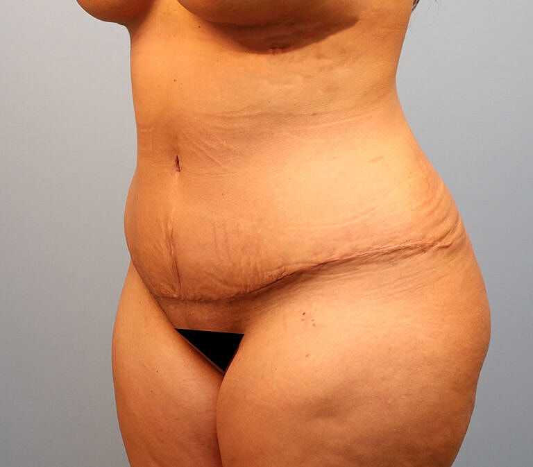 Abdominoplasty Tummy Tuck Before & After