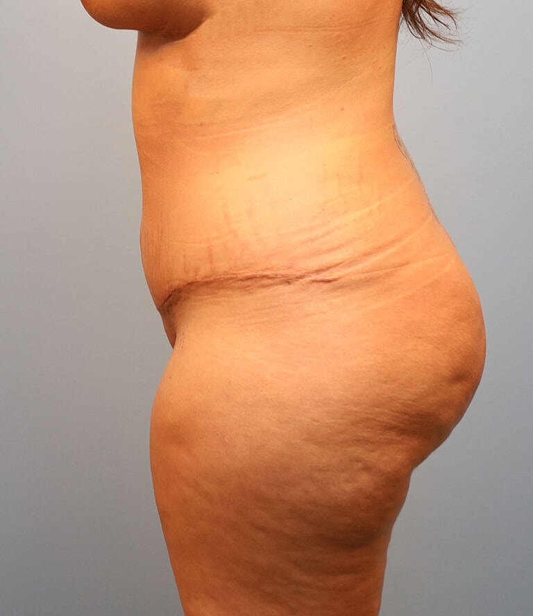 Abdominoplasty Tummy Tuck Before & After