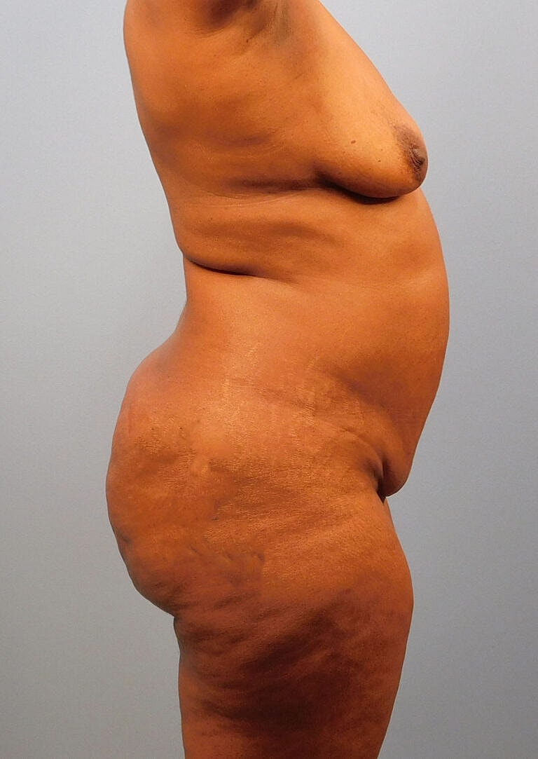 Abdominoplasty Tummy Tuck Before & After