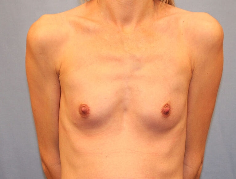 Breast Augmentation Before & After
