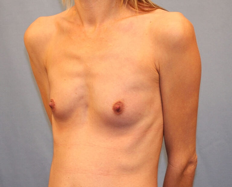 Breast Augmentation Before & After