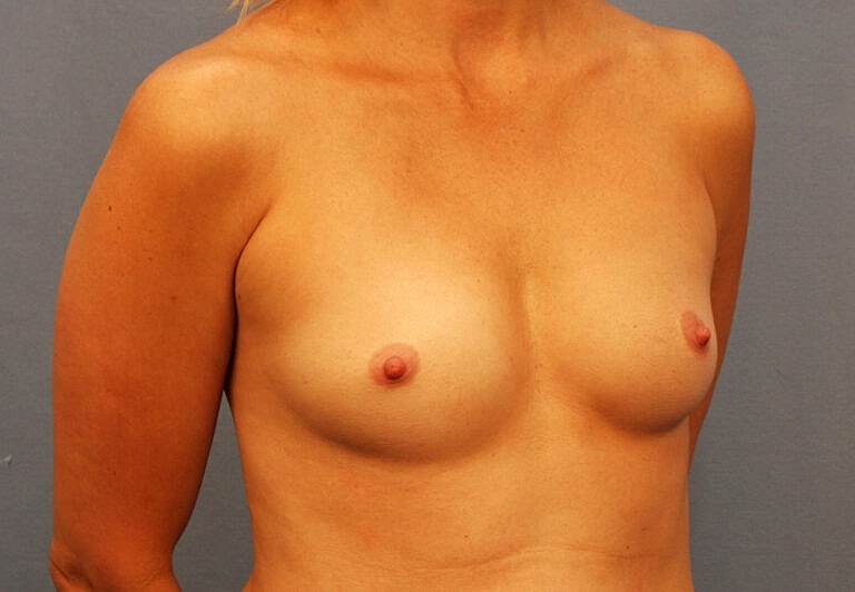Breast Augmentation Before & After