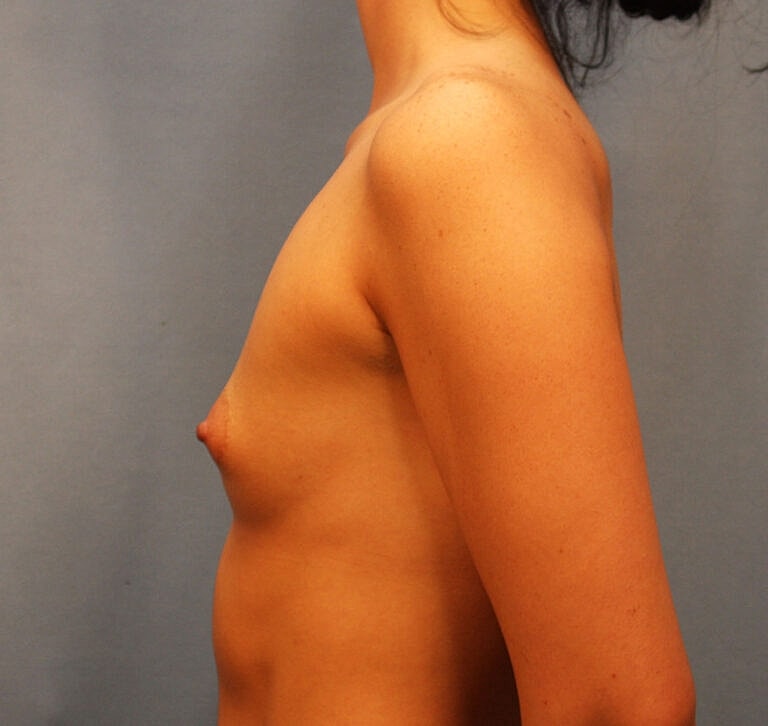 Breast Augmentation Before & After