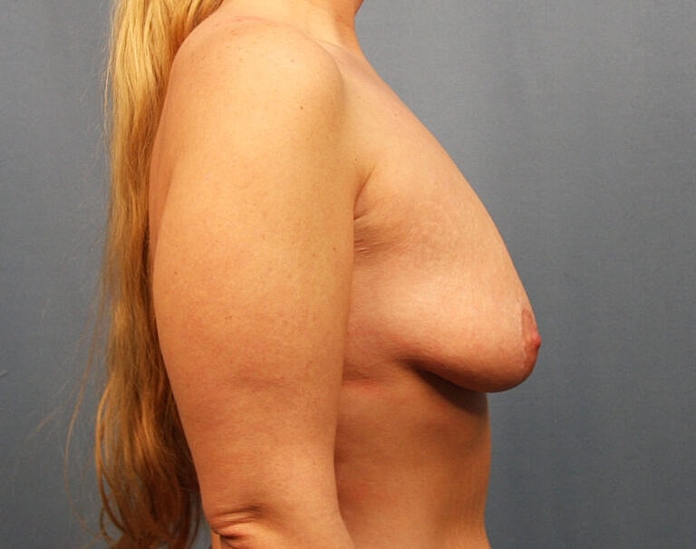 Breast Augmentation Before & After