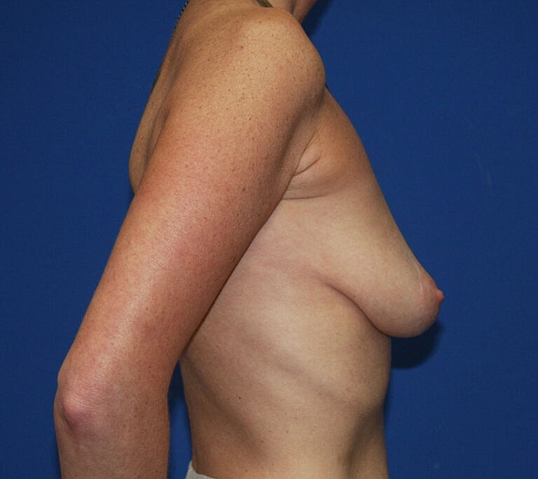 Breast Augmentation Before & After