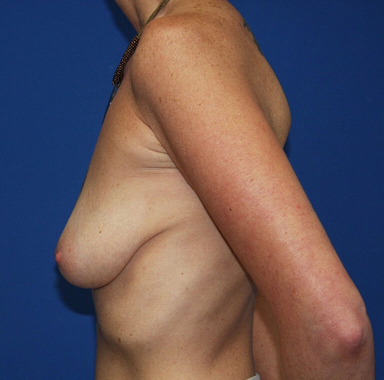 Breast Augmentation Before & After
