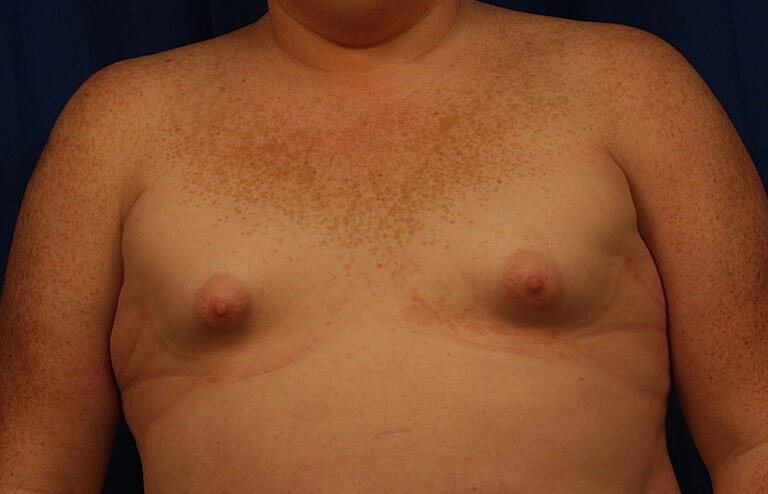 Breast Augmentation Before & After