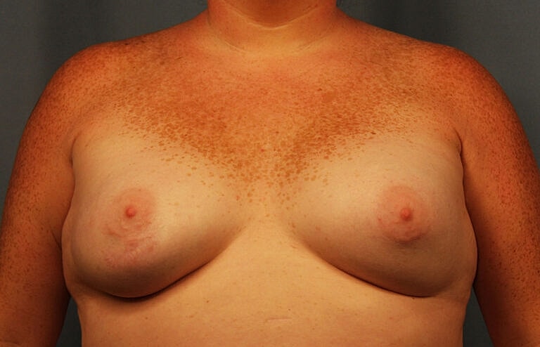 Breast Augmentation Before & After