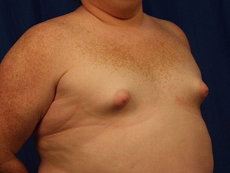 Breast Augmentation Before & After