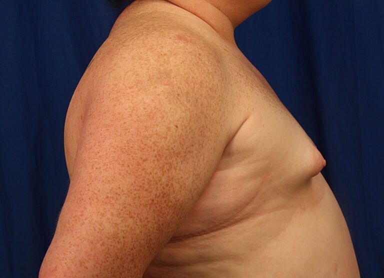 Breast Augmentation Before & After