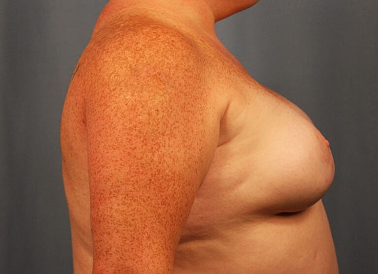 Breast Augmentation Before & After