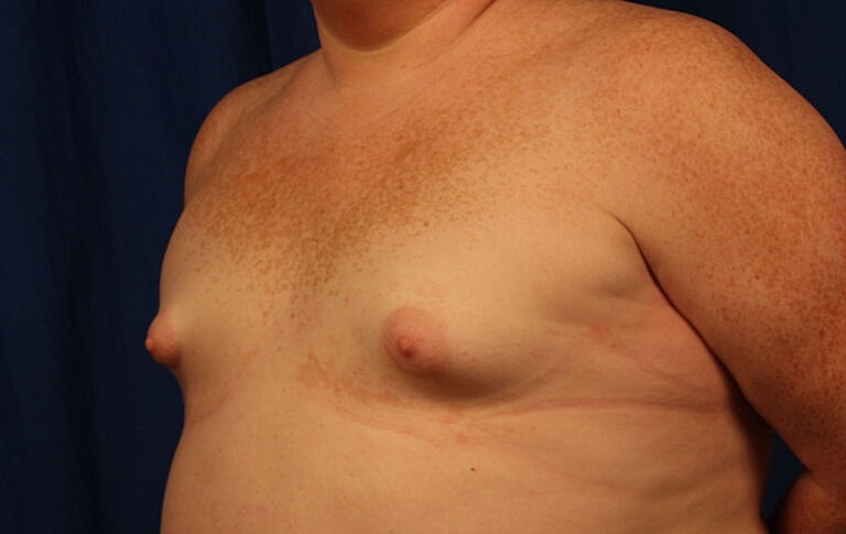 Breast Augmentation Before & After