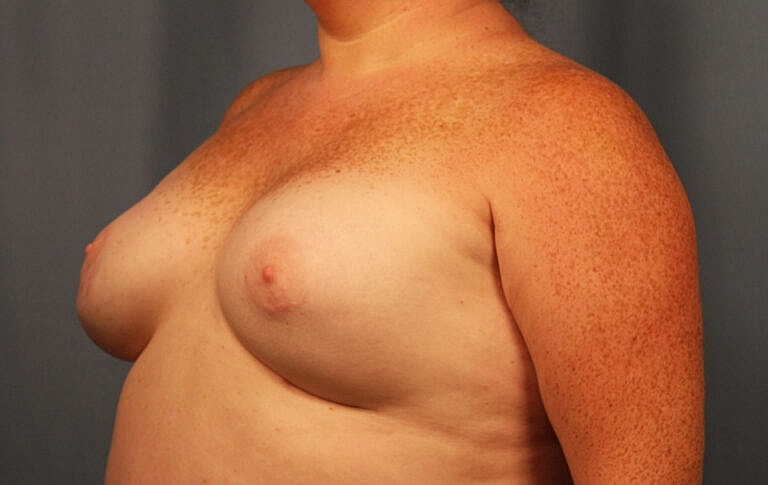 Breast Augmentation Before & After