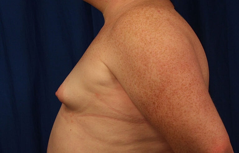 Breast Augmentation Before & After