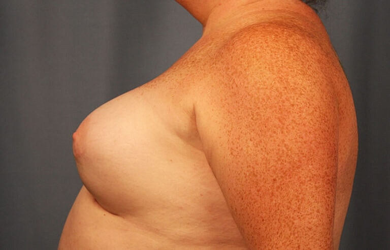 Breast Augmentation Before & After