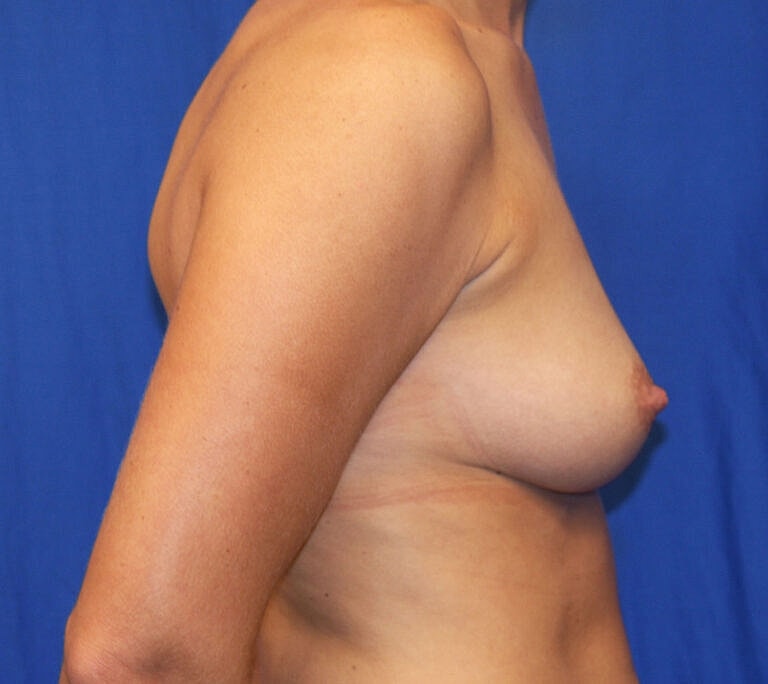 Breast Augmentation Before & After