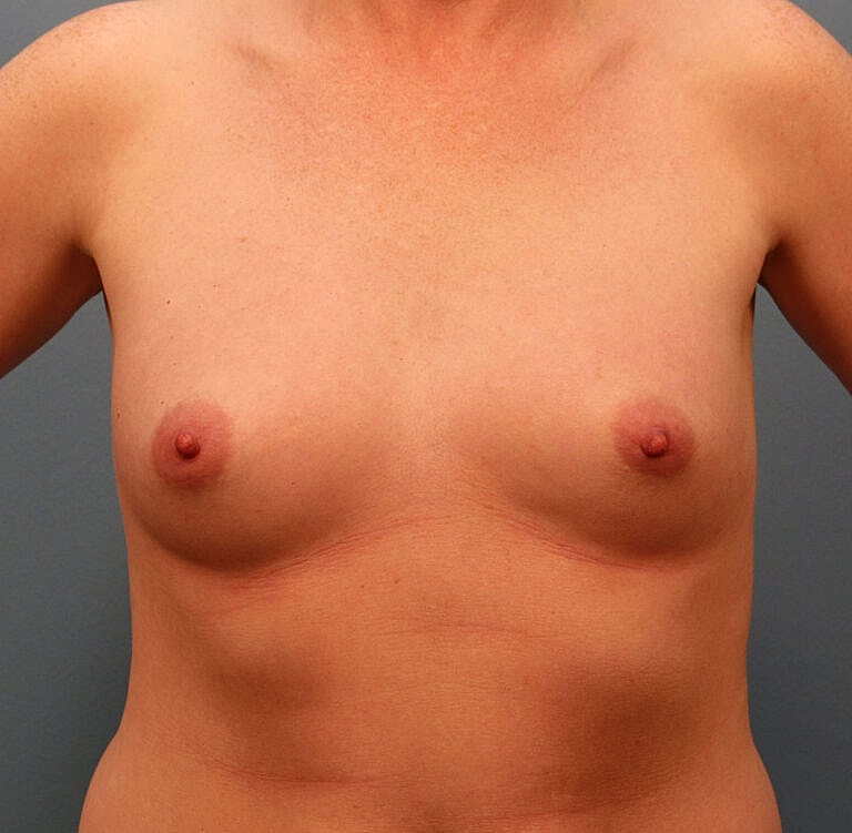 Breast Augmentation Before & After