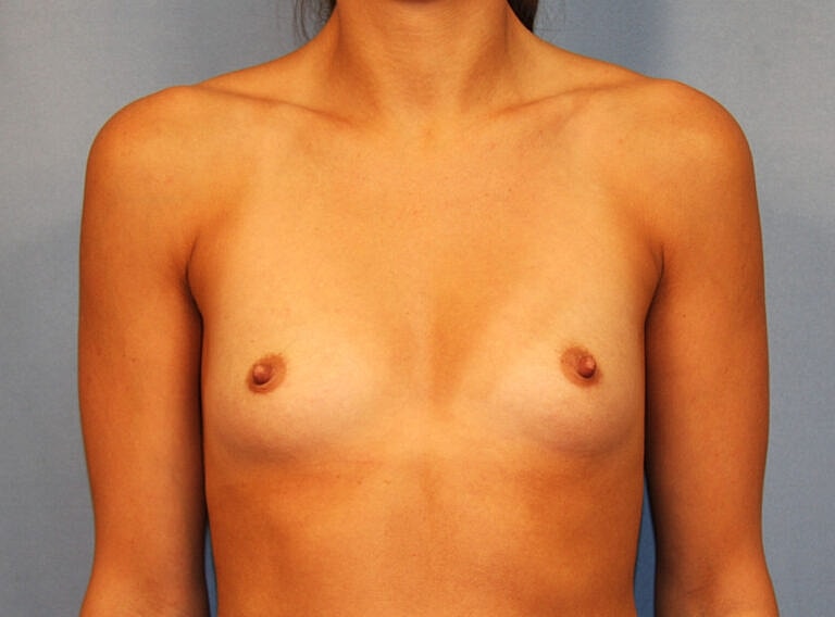 Breast Augmentation Before & After