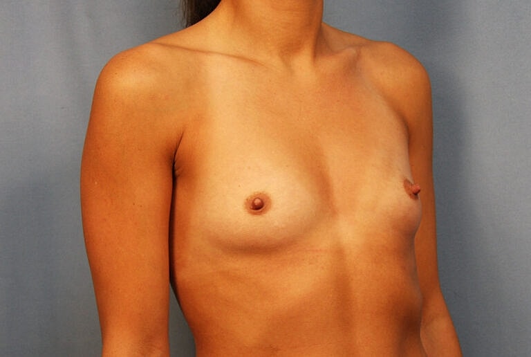 Breast Augmentation Before & After