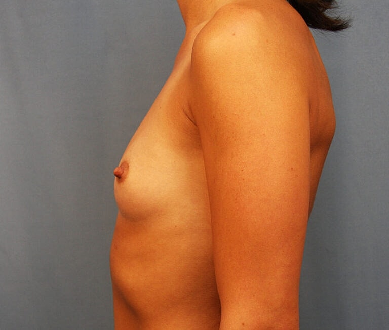 Breast Augmentation Before & After