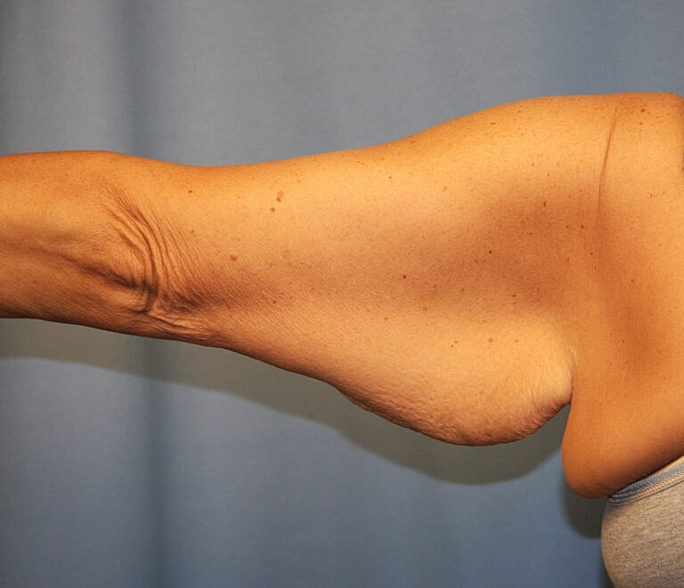 Brachioplasty Before & After