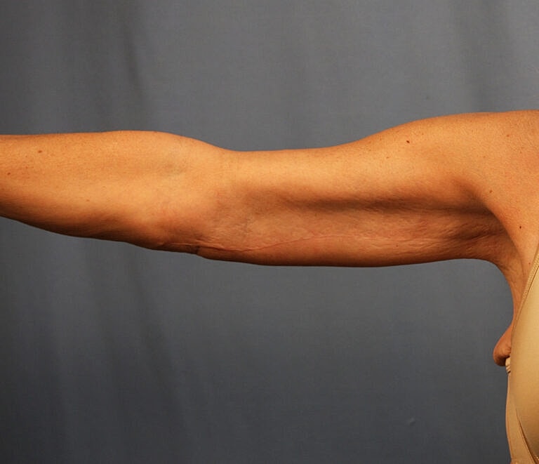 Brachioplasty Before & After
