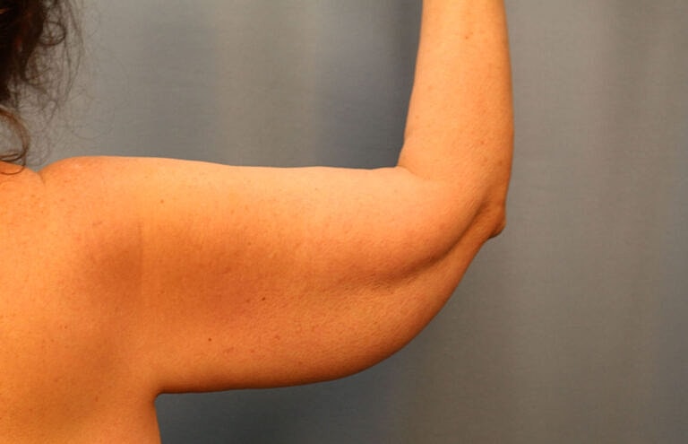 Brachioplasty Before & After