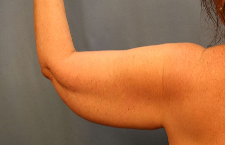 Brachioplasty Before & After