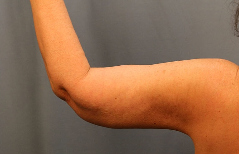 Brachioplasty Before & After