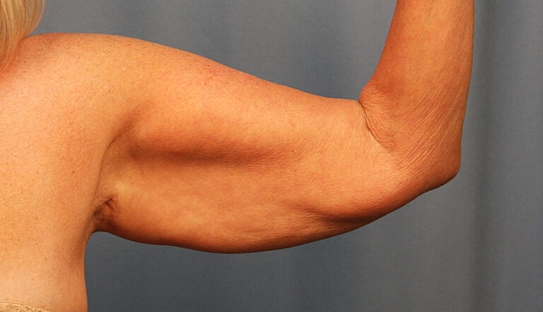 Brachioplasty Before & After