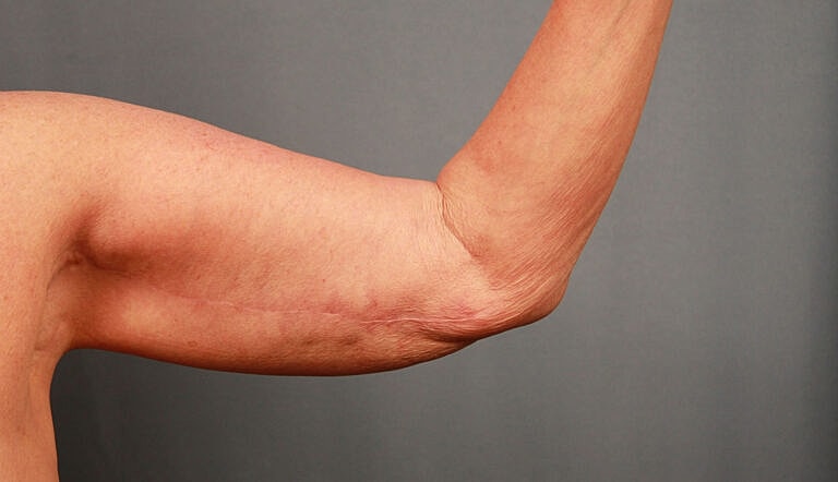 Brachioplasty Before & After