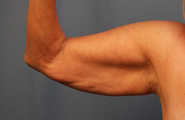 Brachioplasty Before & After