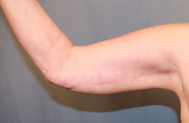 Brachioplasty Before & After