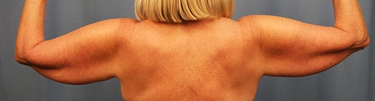 Brachioplasty Before & After