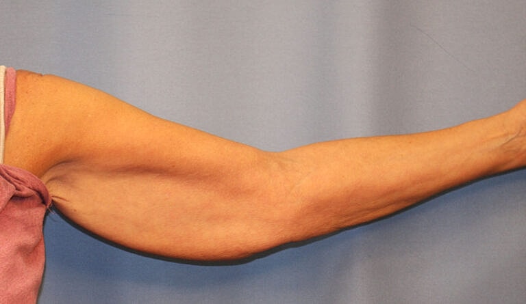 Brachioplasty Before & After