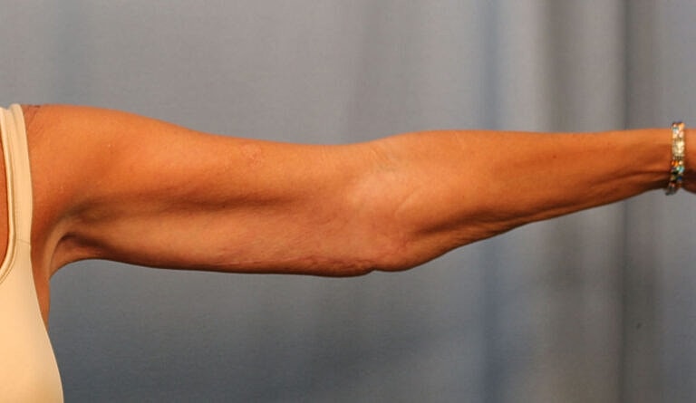 Brachioplasty Before & After
