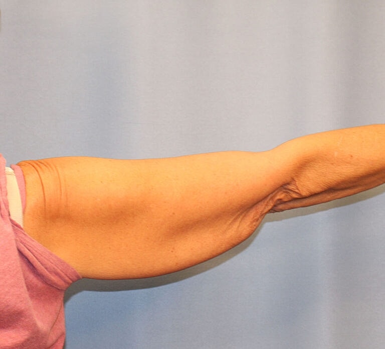 Brachioplasty Before & After