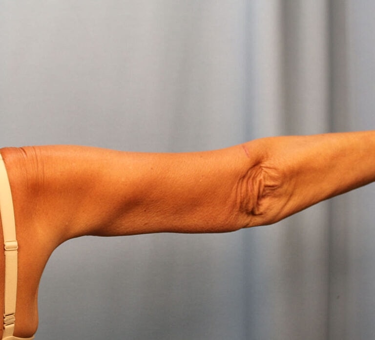 Brachioplasty Before & After