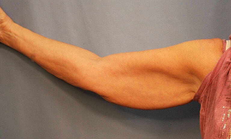 Brachioplasty Before & After